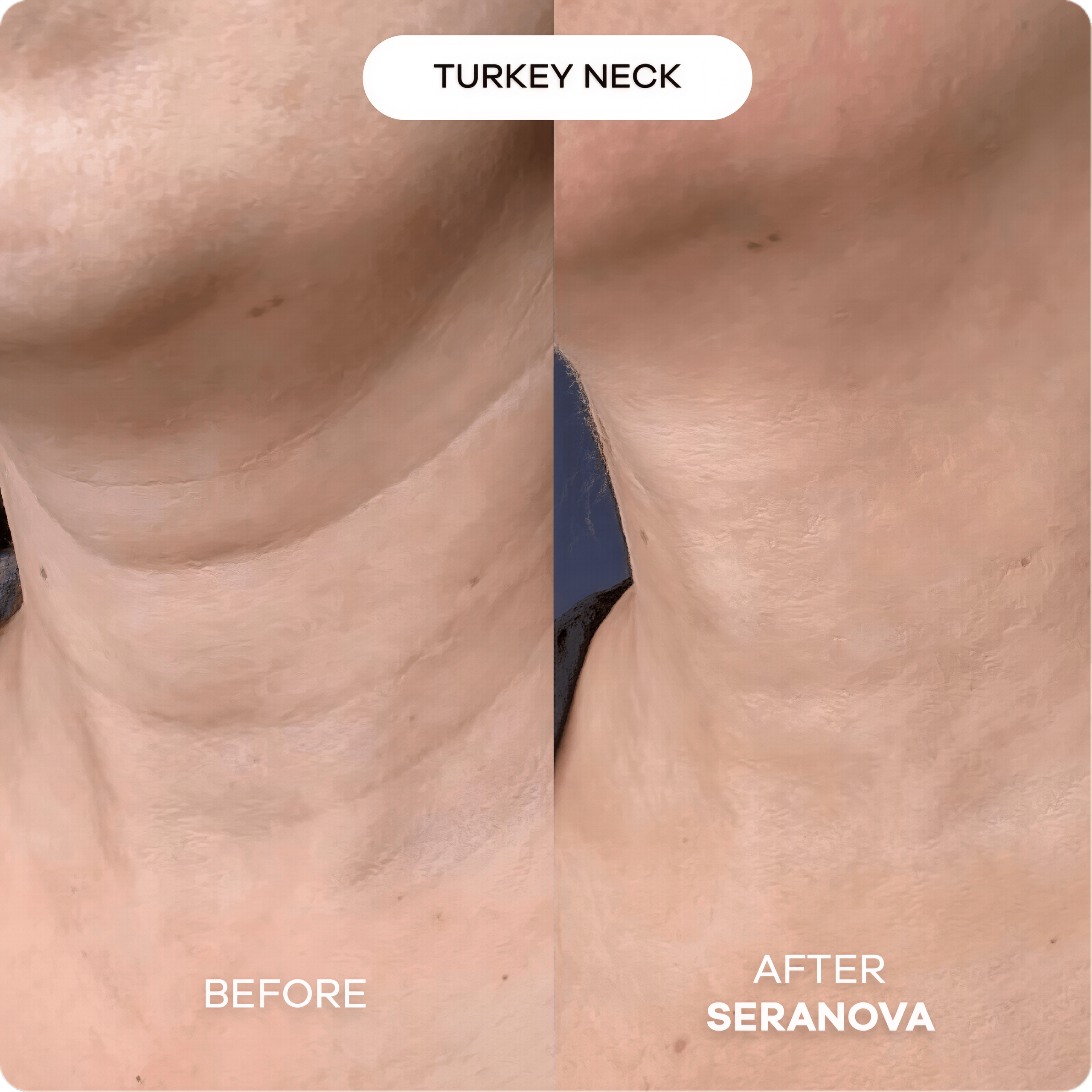 Seranova Micro Infusion Hyaluronic Acid Collagen Peptide 3 Month Supply